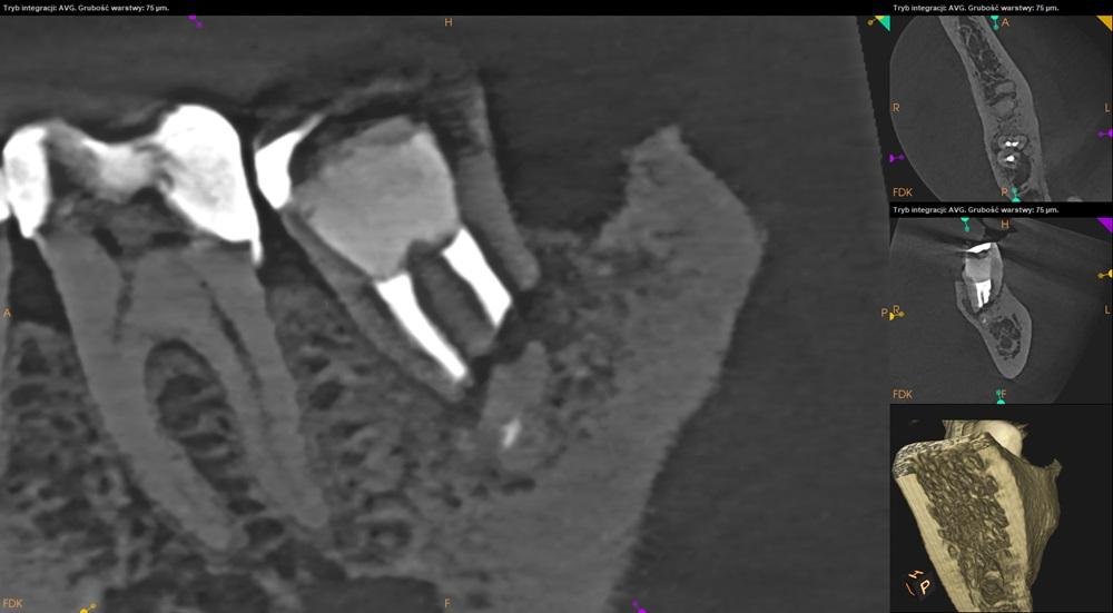 Tomografia CBCT żuchwy